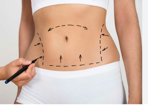 Cost of a Tummy Tuck in Miami: Investment and Financing Options